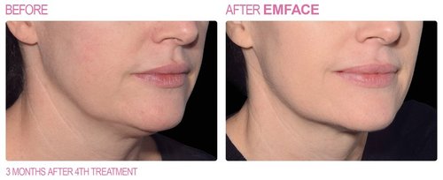 EmFace Before and After - emface4