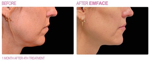 EmFace Before and After - emface5