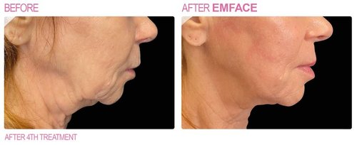 EmFace Before and After - emface6