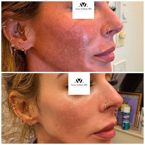 Picosure / Laser Skin Rejuvenation Before and After - exosome-for-melasma-before-and-after