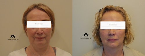 Fillers Before and After - f2