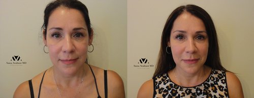 Fillers Before and After - f3