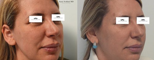 Fillers Before and After - f5