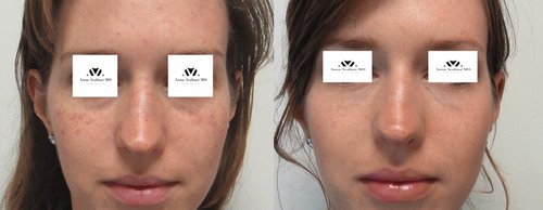 Fillers Before and After - f8