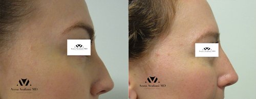 Fillers Before and After - f9