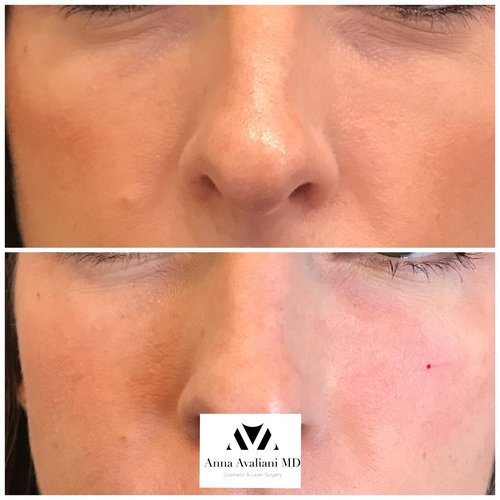 Fillers Before and After - ff1-1