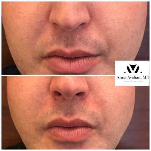 Fillers Before and After - ff2-1