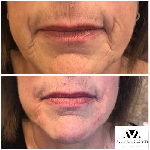 Fillers Before and After - ff3-1