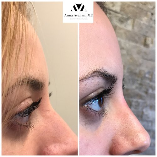 Fillers Before and After - ff4-1