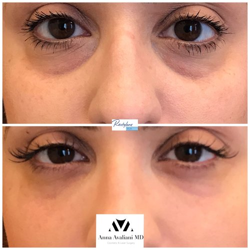 Fillers Before and After - ff5