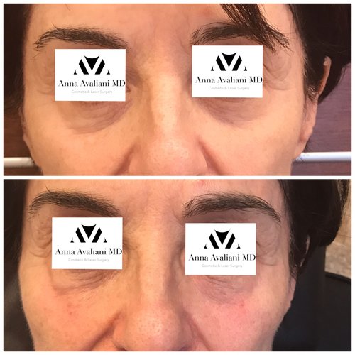 Fillers Before and After - ff6