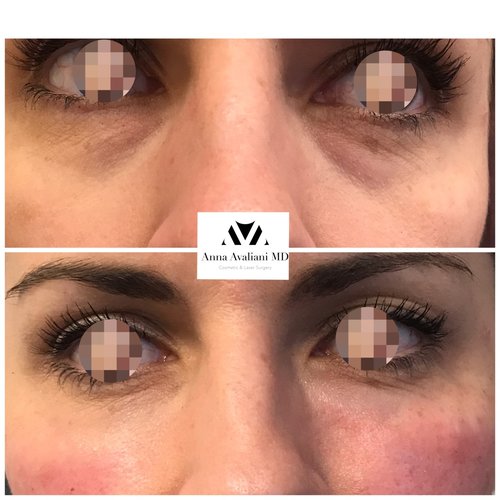 Fillers Before and After - ff7