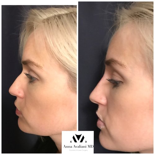 Fillers Before and After - ff8