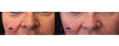 Fillers Before and After - fill111