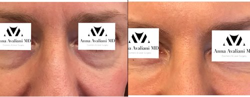 Fillers Before and After - fl2