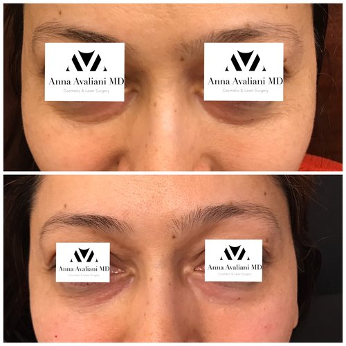 Fillers Before and After - flr1