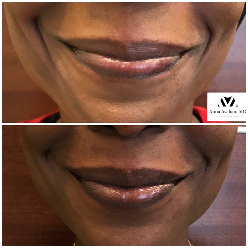 Fillers Before and After - flr2