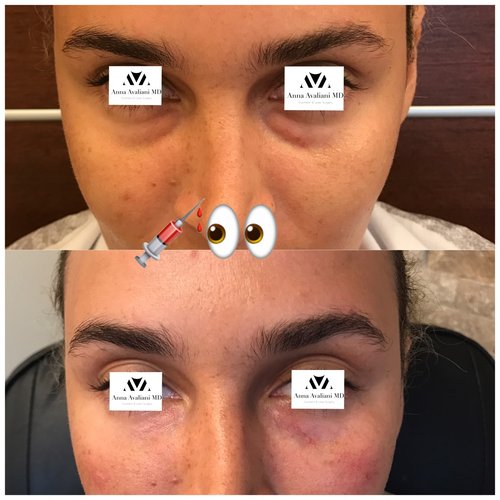 Fillers Before and After - flr3