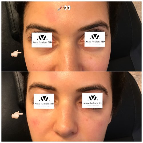 Fillers Before and After - flr4