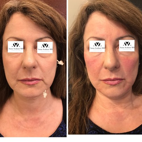 Fillers Before and After - flr5