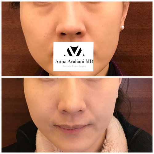 Fillers Before and After - flr6