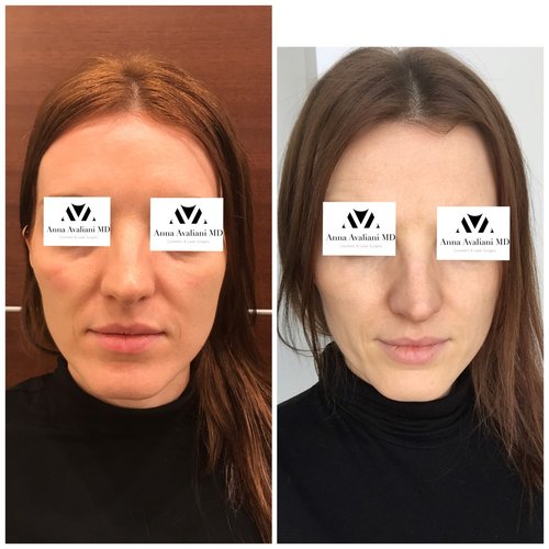 Fillers Before and After - flr7