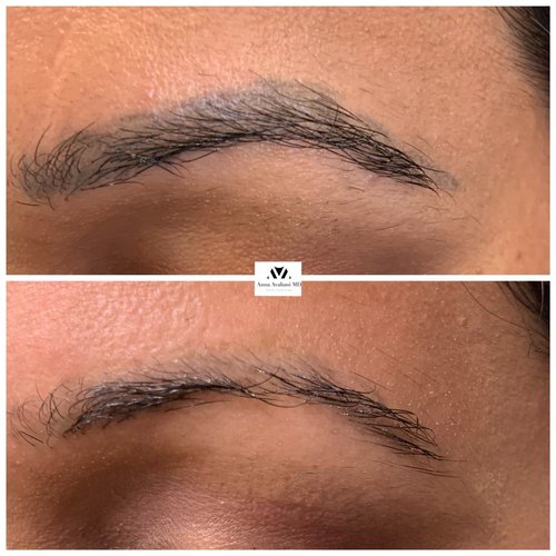 Tattoo Eyebrow Removal Before and After - j8AwdEXuT6gOx8BWnMe479VyNUZPwXY1Pg
