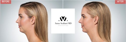 Kybella Before and After - k10