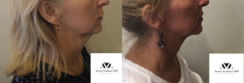 Kybella Before and After - k111