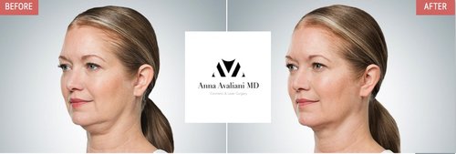 Kybella Before and After - k2