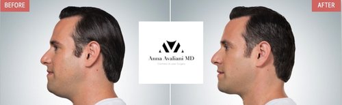 Kybella Before and After - k3