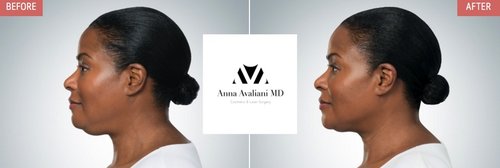 Kybella Before and After - k4