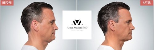 Kybella Before and After - k5