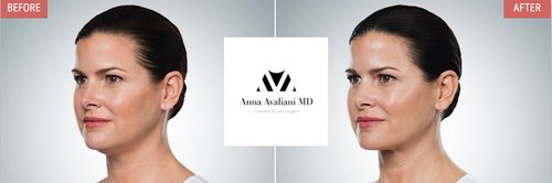 Kybella Before and After - k6