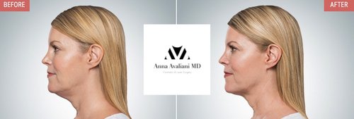 Kybella Before and After - k7