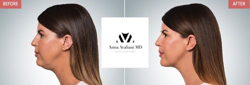 Kybella Before and After - k8