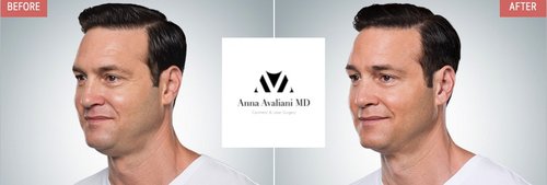 Kybella Before and After - k9