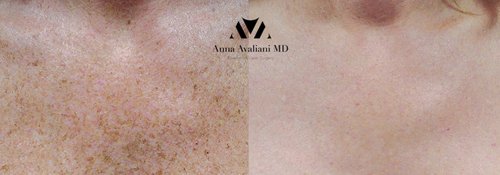 Picosure / Laser Skin Rejuvenation Before and After - l1