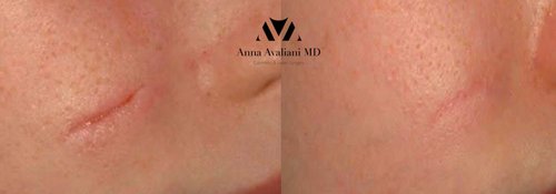 Picosure / Laser Skin Rejuvenation Before and After - l2