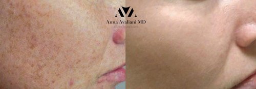 Picosure / Laser Skin Rejuvenation Before and After - l3