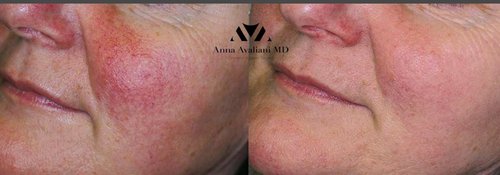Picosure / Laser Skin Rejuvenation Before and After - l4