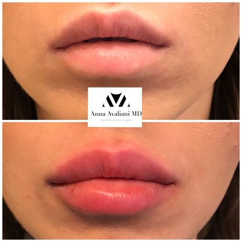 Lip Augmentation Before and After - laa1