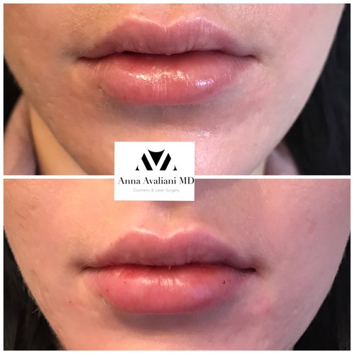 Lip Augmentation Before and After - laa10