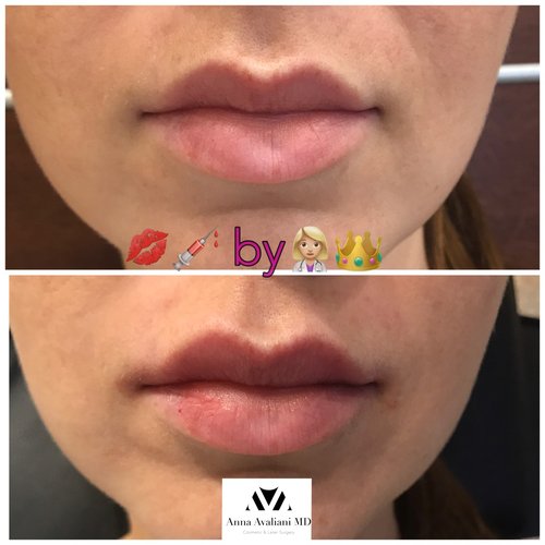Lip Augmentation Before and After - laa11
