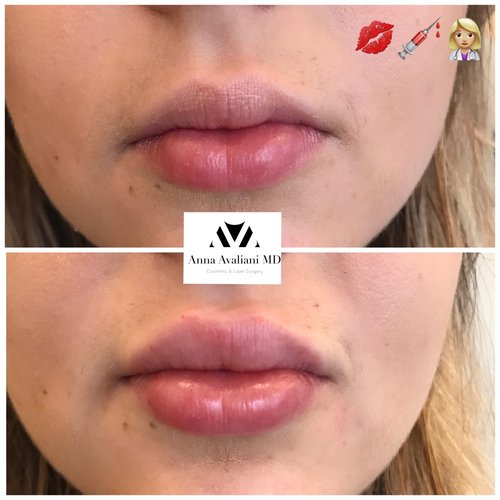 Lip Augmentation Before and After - laa12