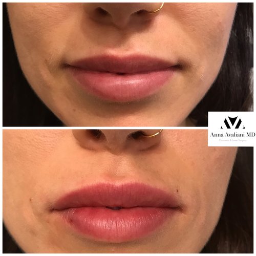 Lip Augmentation Before and After - laa13