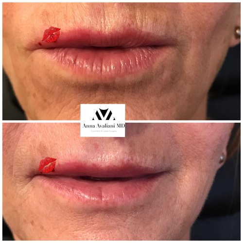 Lip Augmentation Before and After - laa14