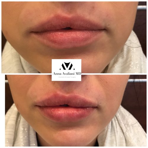 Lip Augmentation Before and After - laa15