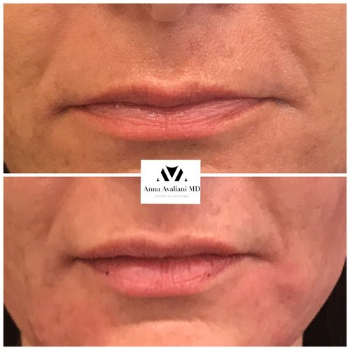 Lip Augmentation Before and After - laa16
