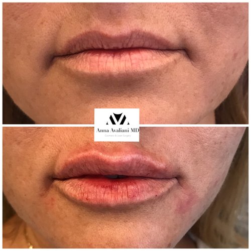 Lip Augmentation Before and After - laa17